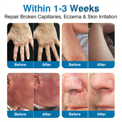 🇬🇧👨‍⚕️🌟🏅QIAWI® VeinRepair Microneedle Patch Roll⚡Instant Relief, Long-Term Results