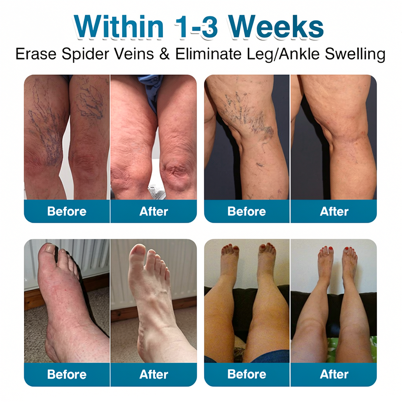 🇬🇧👨‍⚕️🌟🏅QIAWI® VeinRepair Microneedle Patch Roll⚡Instant Relief, Long-Term Results