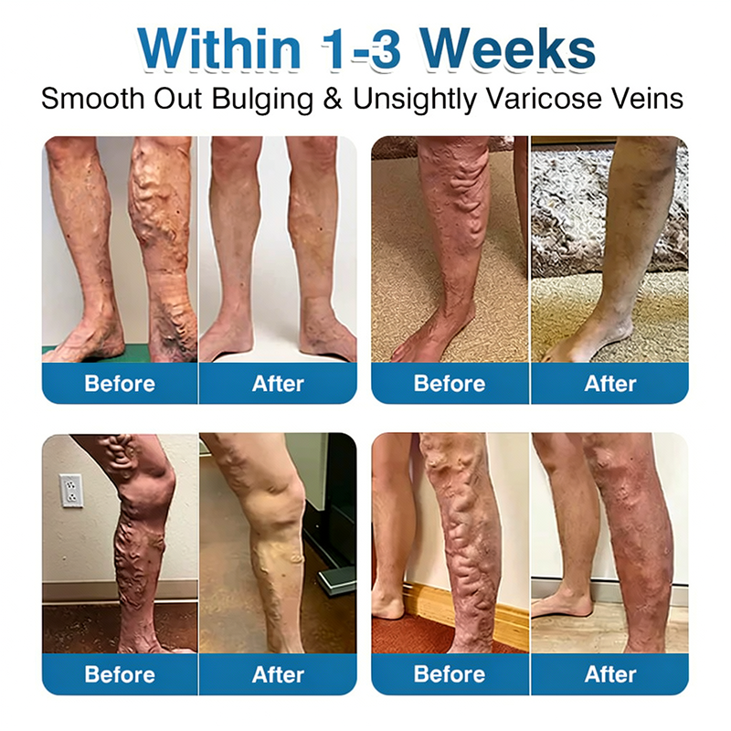 🇬🇧👨‍⚕️🌟🏅QIAWI® VeinRepair Microneedle Patch Roll⚡Instant Relief, Long-Term Results