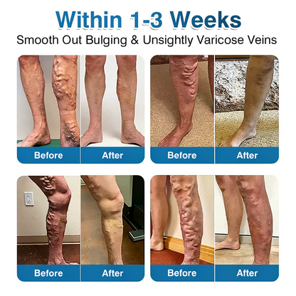 🇬🇧👨‍⚕️🌟🏅QIAWI® VeinRepair Microneedle Patch Roll⚡Instant Relief, Long-Term Results